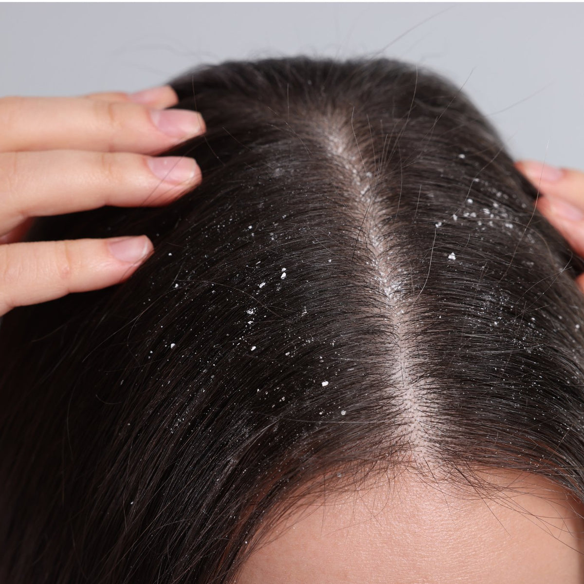 Dandruff 101